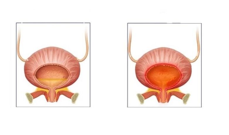 Normale und Patienten mit Harnwegskystitis