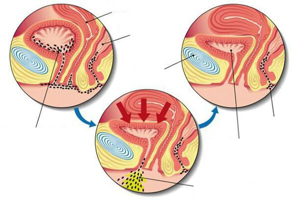 Bakterien in der Blase bei Blasenentzündung